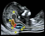 Imagen ecográfica fetal con anotaciones.